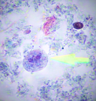 <strong>Figure 1.</strong> <i>Dientamoeba fragilis</i> trophozoites. (Trichrome stain, x1000; Archive of Manisa Celal Bayar University School of Medicine Department of Medical Parasitology)
