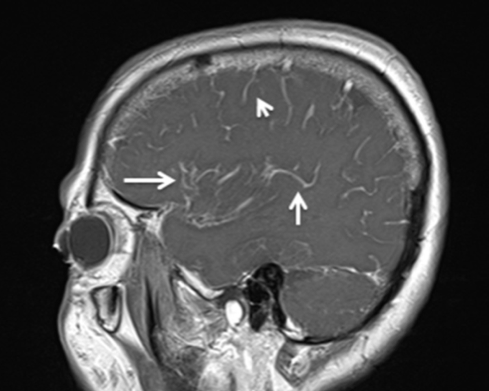 <strong>Figure 1.</strong> Sagittal plane T1 MRI image after contrast injection showed diffuse and increased enhancement of arachnoid matter (white arrows)