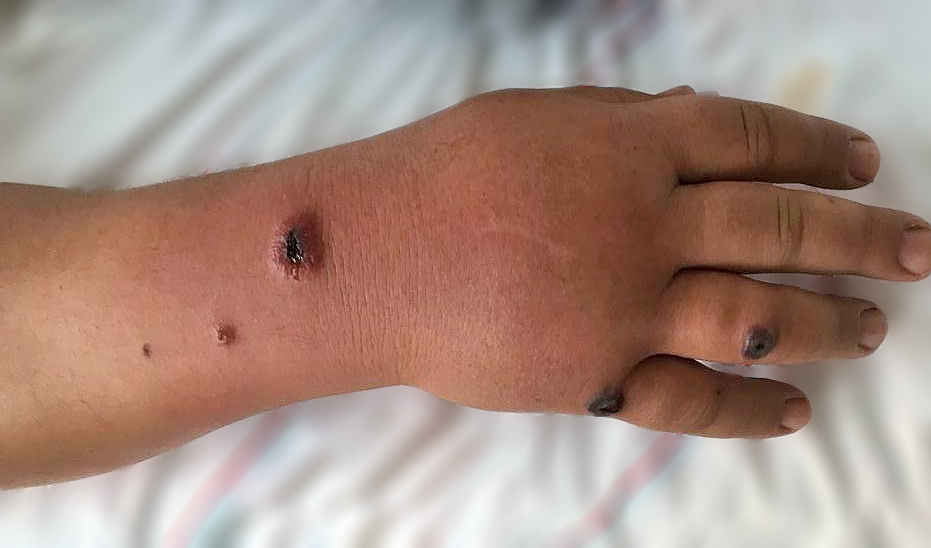 <strong>Figure 1</strong> Multiple dark papules with central umbilicus on patient’s right hand and on the 4<sup>th</sup> and the 5<sup>th</sup> fingers including diffuse edema.