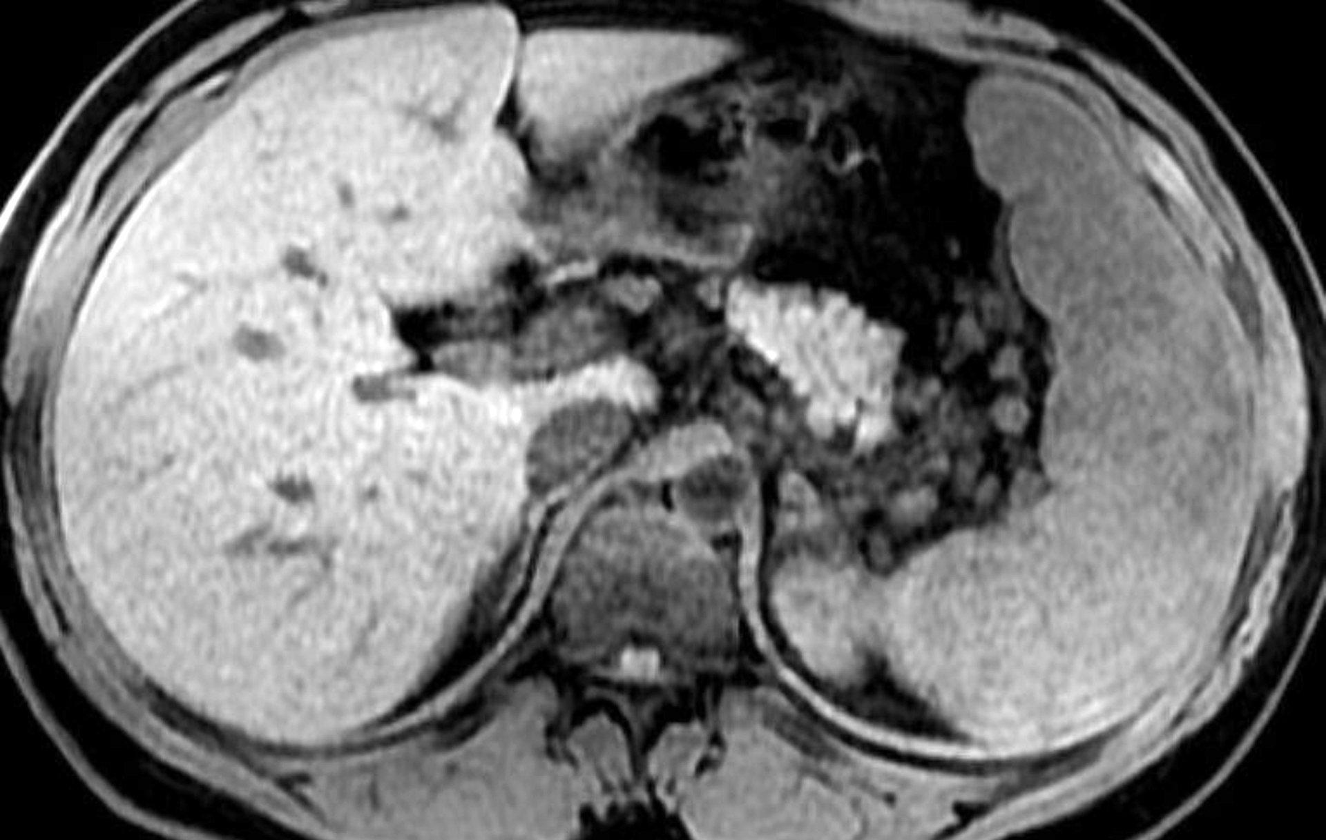 <strong>Figure 3.</strong> Patient 1: Magnetic resonance imaging T1 weighted sequence of the abdomen. Unenhanced axial T1-weighted fat-saturated 3 -dimensional image shows minimal heterogeneity of the spleen. 