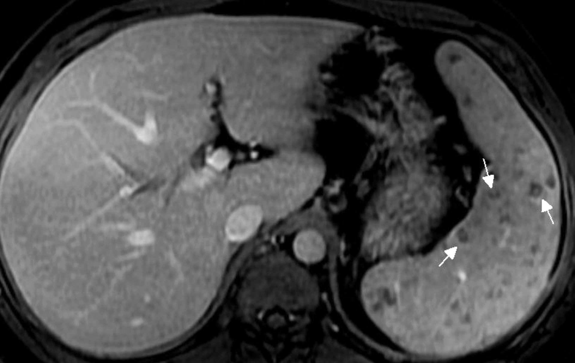 <strong>Figure 4.</strong> Patient 1: Magnetic resonance imaging T1 weighted sequence of the abdomen. Following intravenous contrast media administration, many hypointense nodules are seen on portal phase, some with poor peripheral enhancement. 