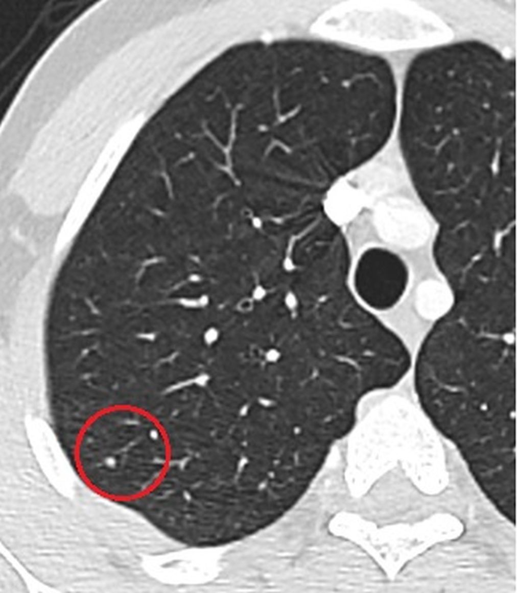 <strong>Figure 2.</strong> The axial CT image which was obtained when the patient had febrile neutropenia shows a new small nodule.