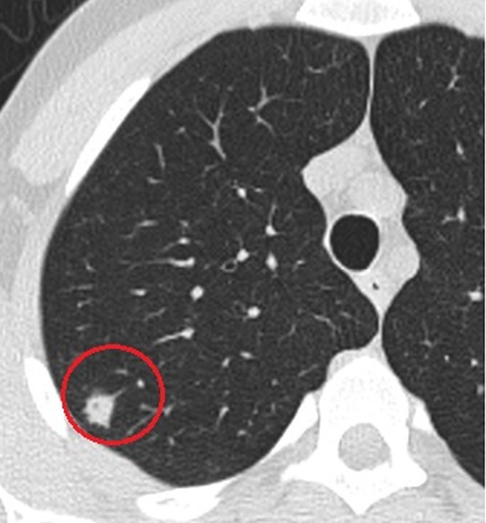 <strong>Figure 3.</strong> Follow-up CT scan which was obtained after 1 week, demonstrates the growing nodule with the halo sign suggesting the angioinvasive aspergillosis.