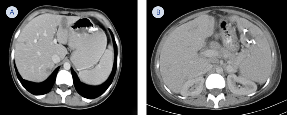 <b>Figure 2. </b>Follow up-scan at the 3rd week of parenteral therapy showing regression of splenic abscess (A) and decreased number of lesions in liver (B).
