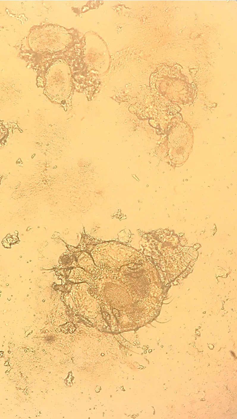 Scabies outbreaks in ten care homes for elderly people: a prospective study  of clinical features, epidemiology, and treatment outcomes - The Lancet  Infectious Diseases