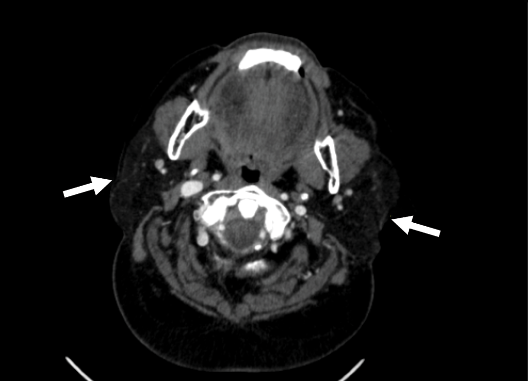 A Case of Acute Parotitis Associated with COVID-19