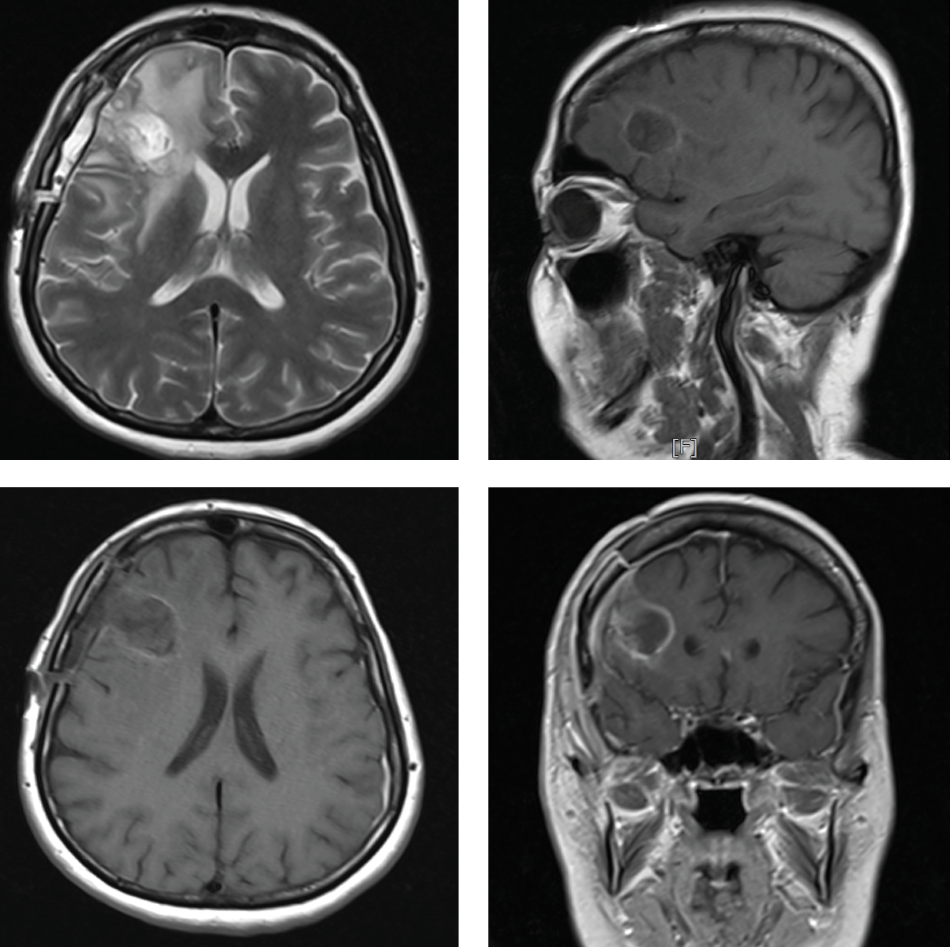 Recurrent Nocardial Brain Abscess Developing in an Immunocompetent Patient, A Case Report