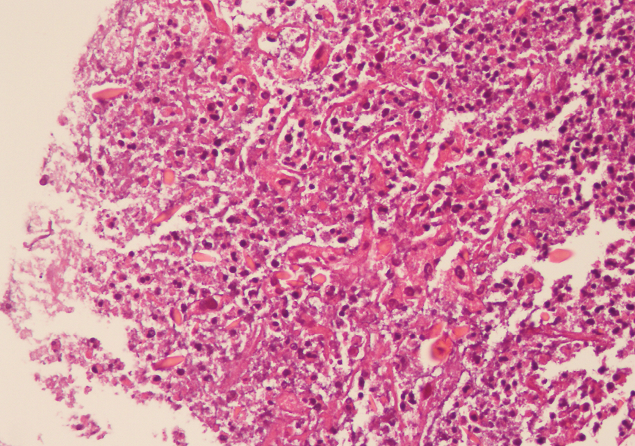 Challenges in Diagnosis and Treatment of Fasciola hepatica Infection