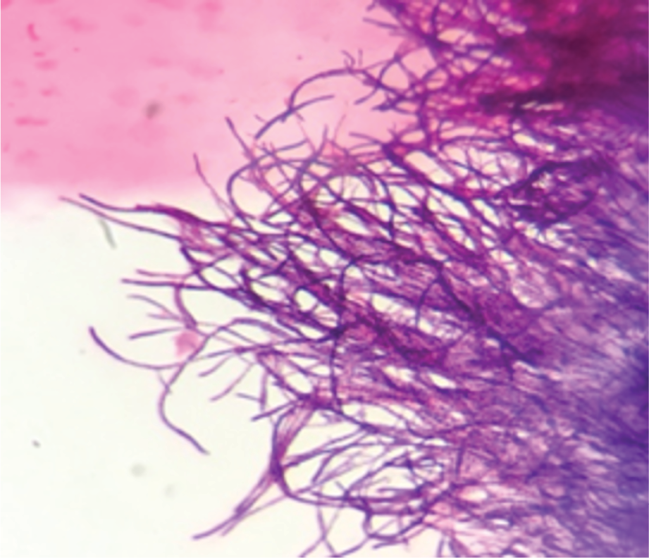 Nocardia Ventriculitis: A Rare Case Report