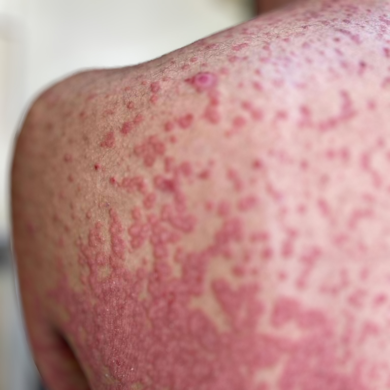 HIV-Associated Pityriasis Rubra Pilaris Type 6: First Case Report from Türkiye