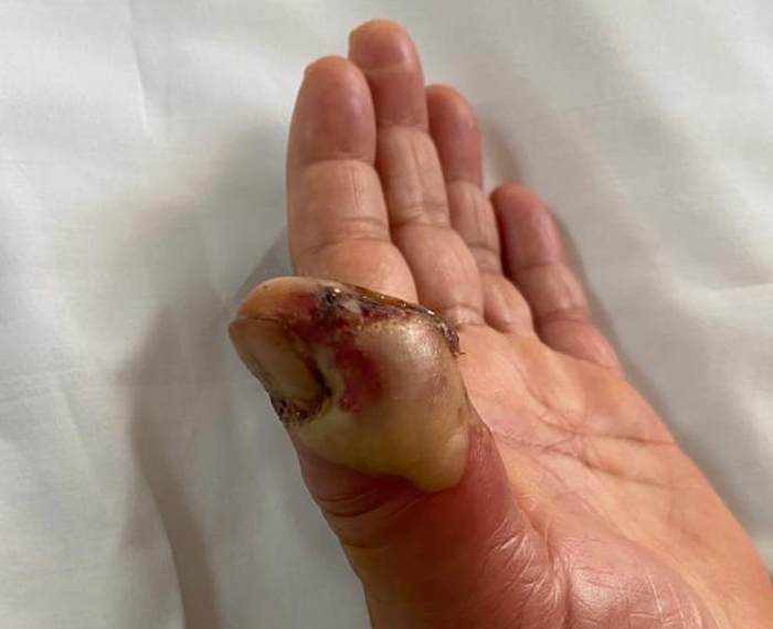 A Diabetic Woman with a Left-Thumb Lesion After Cactus-Thorn Trauma