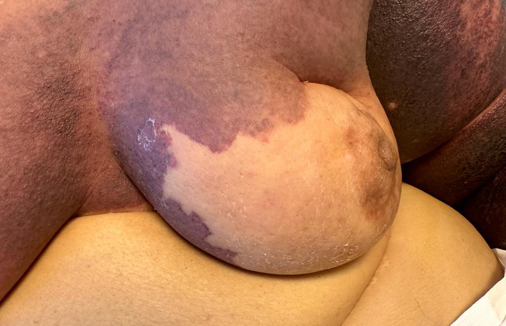Stewart-Treves Syndrome Misdiagnosed as Cellulitis Following the 2023 Kahramanmaraş Earthquake