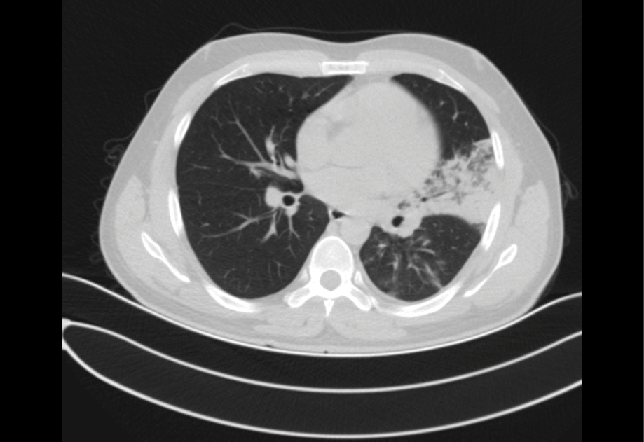 Uncommon Presentation of Mycoplasma pneumoniae: Rash and Mucositis Manifestation