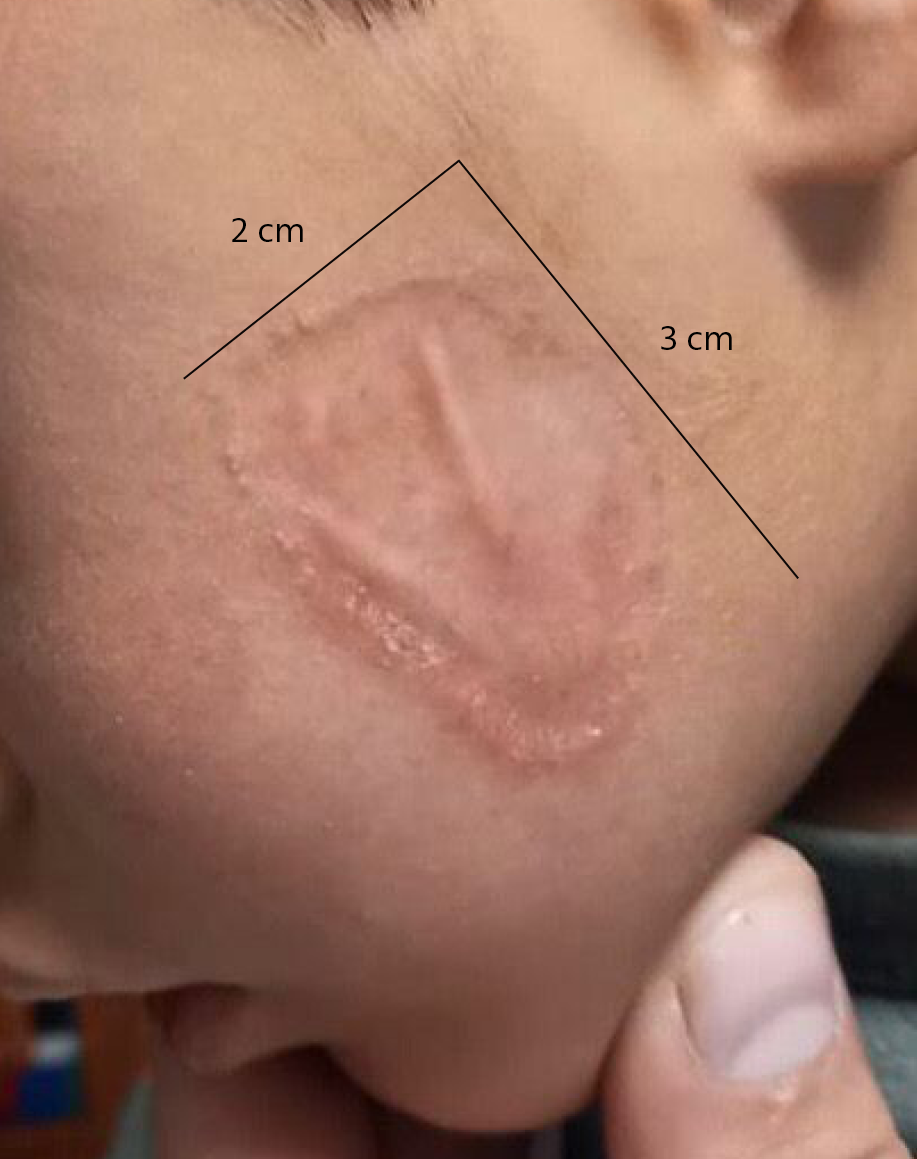 When the Skin Speaks: A Case of Lupus Vulgaris in a Toddler