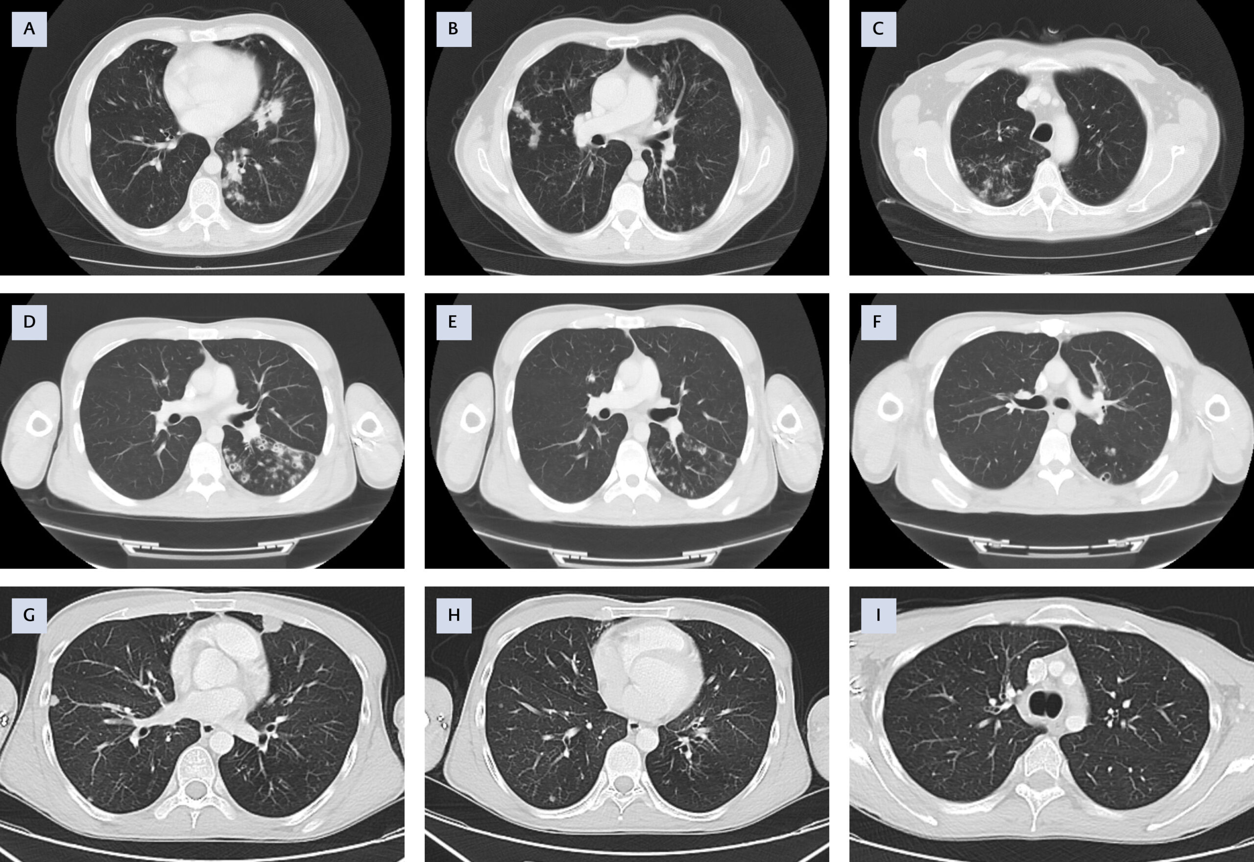 Nontuberculosis Mycobacterial Infections: A Series of 14 Cases from a Tertiary Care Center in Türkiye